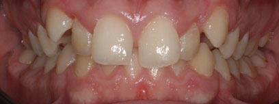 Teath Before Teath Before