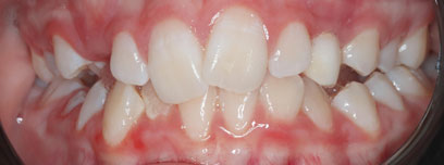 Teath Before Teath Before